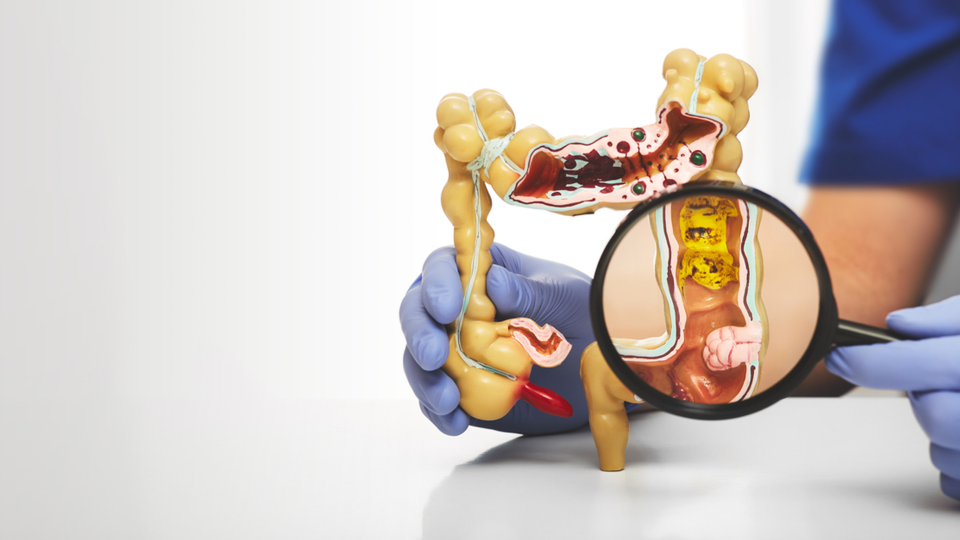 İnflamatuar Bağırsak Hastalıkları