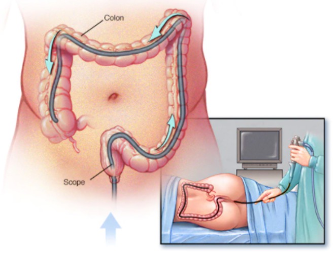 Kolonoskopi
