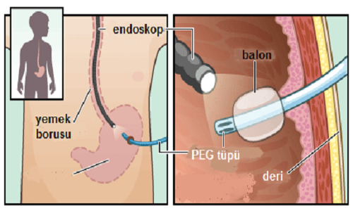 PEG (Perkütan Endoskopik Gastrostomi)
